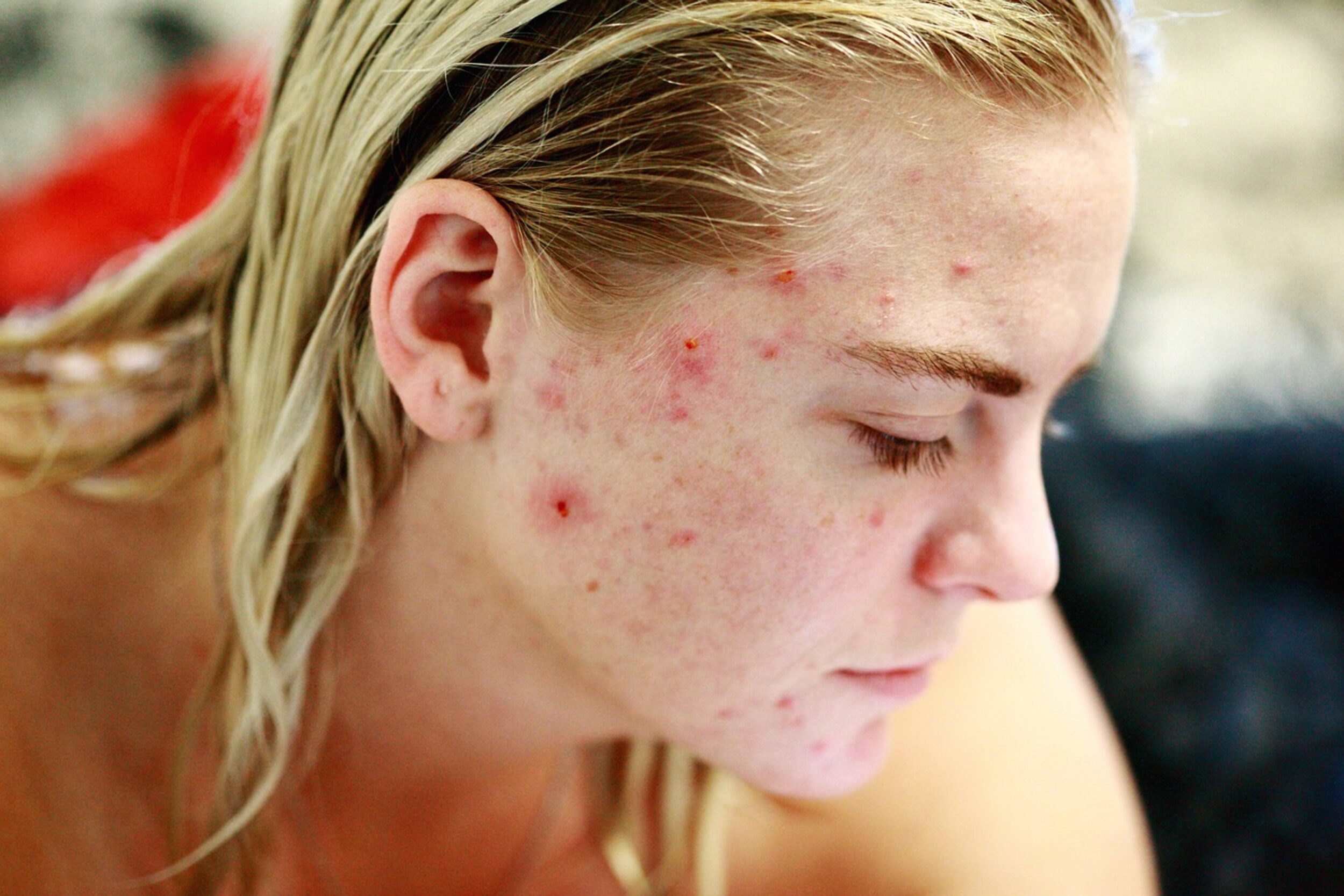 How to Prevent Acne Scarring Naturally: Tips and Treatments.